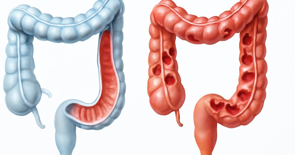 Ulcerative Colitis: Symptoms, Causes & Treatment Options